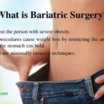 Bariatric Surgery