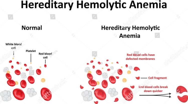 The Many Types Of Hemolytic Anemia You Must Know About Trionds