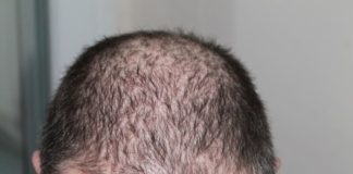 How To Stop Hair Fall For Men Archives Trionds